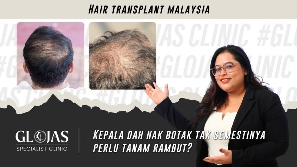 Hair Transplant in Malaysia | Betul ke? Tanam Rambut Solusi Terbaik Untuk Kebotakan? 10 tanam-rambut