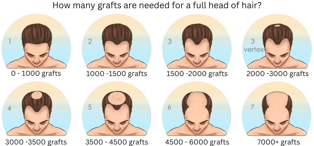 How Many Grafts Do You Need for a Hair Transplant?