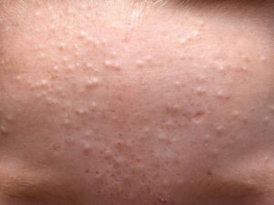 Tiny Bumps On Face: Causes, Types & Effective Treatments