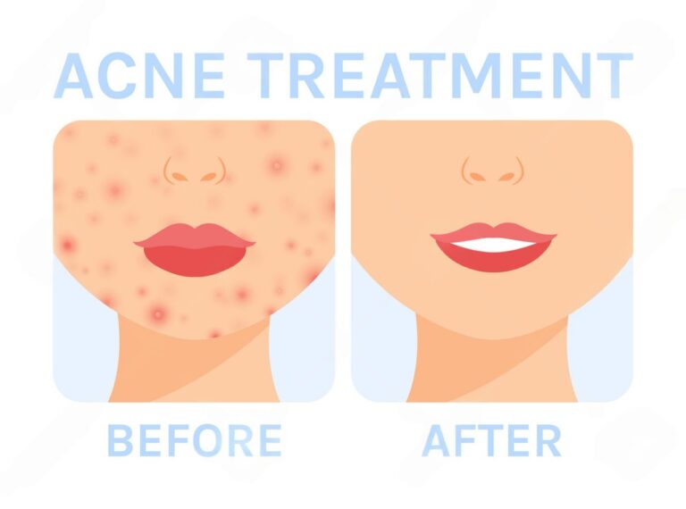 acne-treatment-malaysia-clear-skin