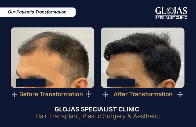 hair-transplant-malaysia-hair-regrowth-male-female-kuala-lumpur-fue-fut-hair-restoration-clinic