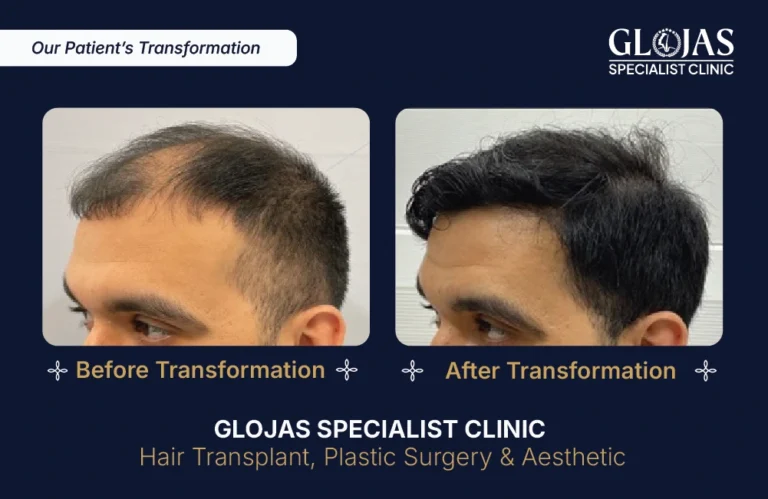 Haartransplantation