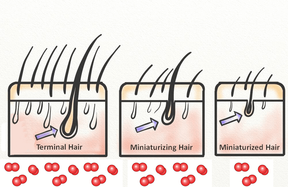 Is Minoxidil the Best Hair Loss Treatment For Hair Regrowth in Malaysia? 2 minoxidil-malaysia-benefit-price-hair-loss-dht