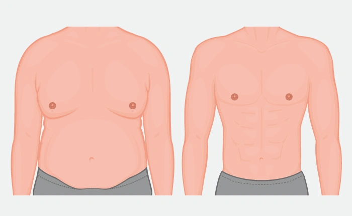 gynecomastia-surgery-malaysia-treatment