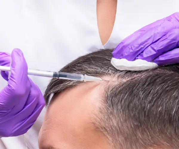 hair-loss-treatment-malaysia-prp