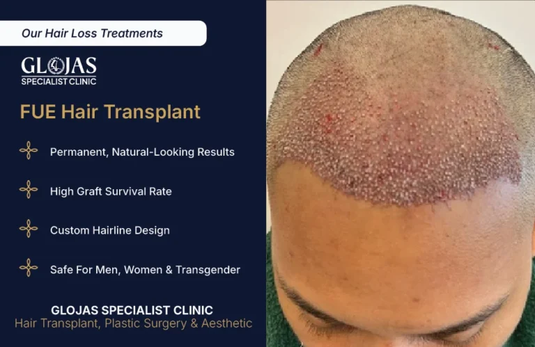 hair-loss-treatment-hair-transplant-fue