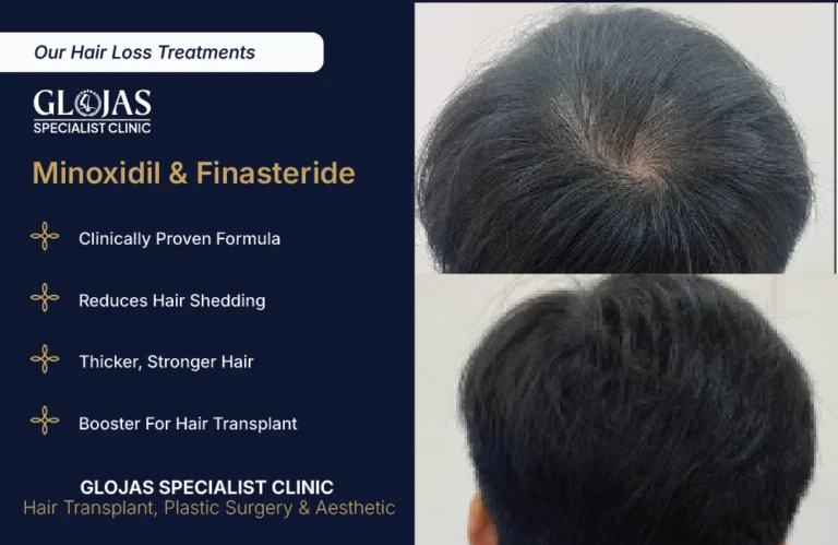 hair-loss-treatment-minoxidil-finasteride
