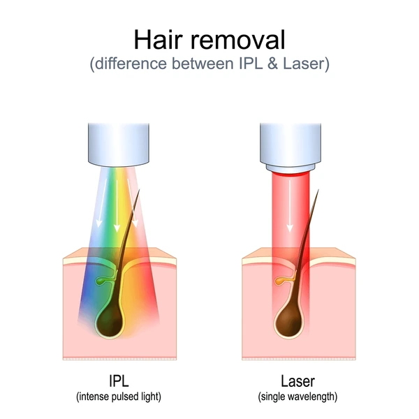 hair-removal-laser-diode-vs-ipl
