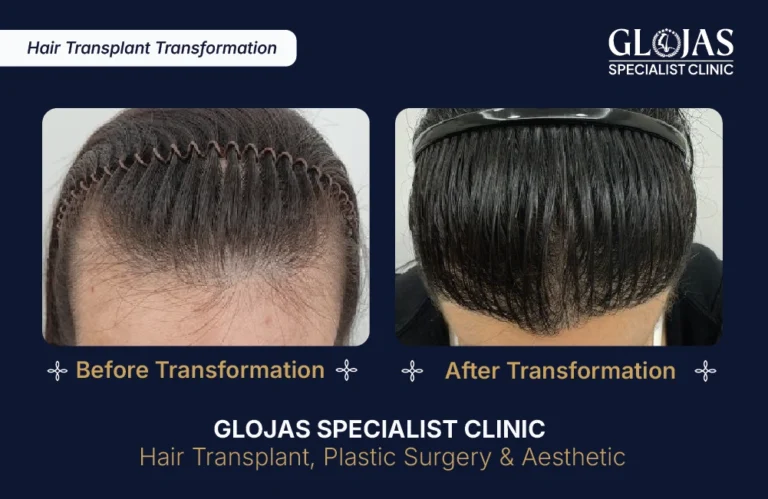 hair-transplant-malaysia-hair-regrowth-male-female-kuala-lumpur-fue-fut-hair-restoration-clinic-lowering-hairline
