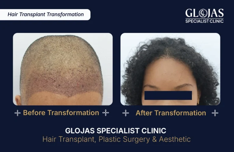 hair-transplant-malaysia-hair-regrowth-male-female-kuala-lumpur-fue-fut-hair-restoration-clinic