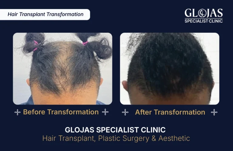 hair-transplant-malaysia-hair-regrowth-male-female-kuala-lumpur-fue-fut-hair-restoration-clinic