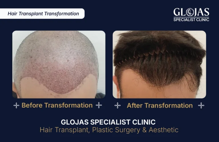 hair-transplant-malaysia-hair-regrowth-male-female-kuala-lumpur-fue-fut-hair-restoration-clinic