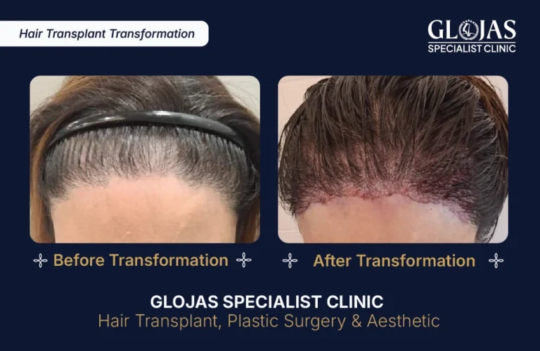 hair-transplant-malaysia-hair-regrowth-male-female-kuala-lumpur-fue-fut-hair-restoration-clinic