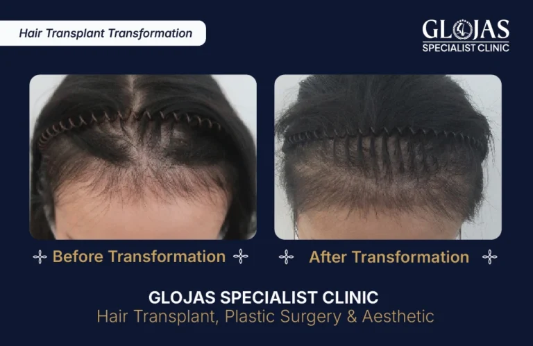 hair-transplant-malaysia-hair-regrowth-male-female-kuala-lumpur-fue-fut-hair-restoration-clinic