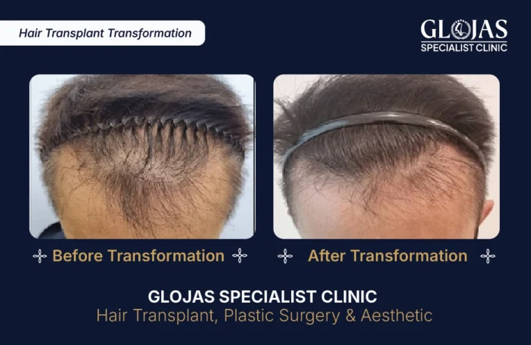 hair-transplant-malaysia-hair-regrowth-male-female-kuala-lumpur-fue-fut-hair-restoration-clinic