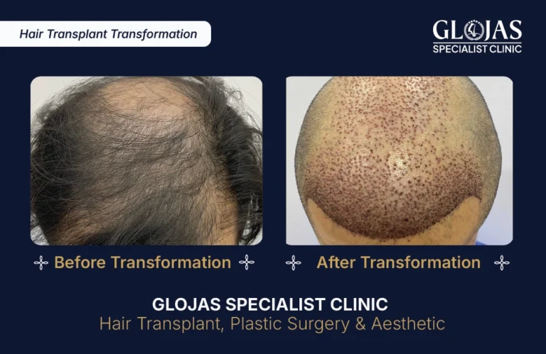 hair-transplant-malaysia-hair-regrowth-male-female-kuala-lumpur-fue-fut-hair-restoration-clinic