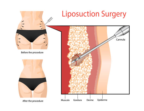 liposuction-surgery-malaysia-affordable-clinic-liposuction-procedure