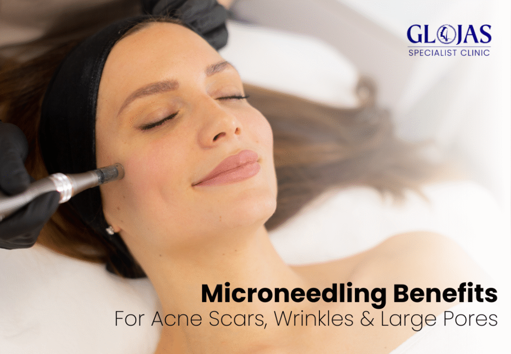 microneedling
