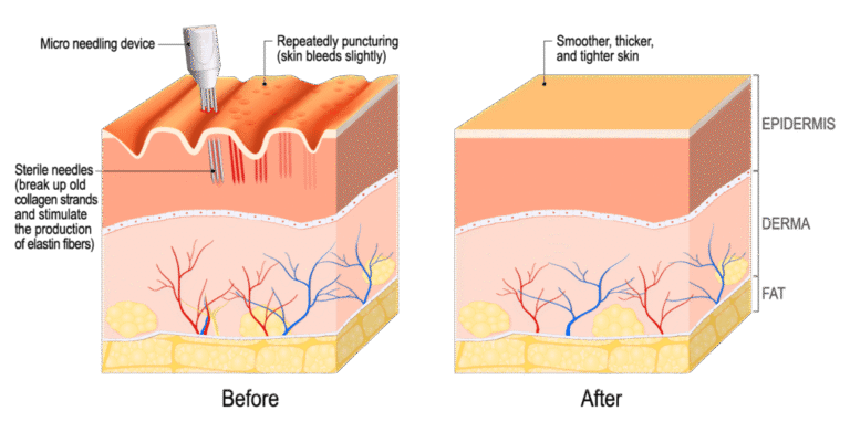 Before and after comparison of skin texture showing improved smoothness and reduced acne scars following microneedling treatment.