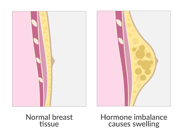 gynecomastia-surgery-malaysia-treatment