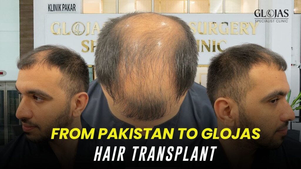 hair-transplant