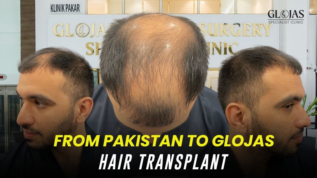 Hair Restoration Pakistan Success Story | Ahmed’s 8-Month Transformation at Glojas Specialist Clinic
