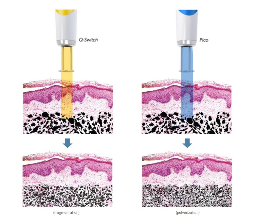 Pico Laser vs Q-Switched Laser: Which Is Best for Pigmentation? 1 Q-Switched Laser-pico laser comparison