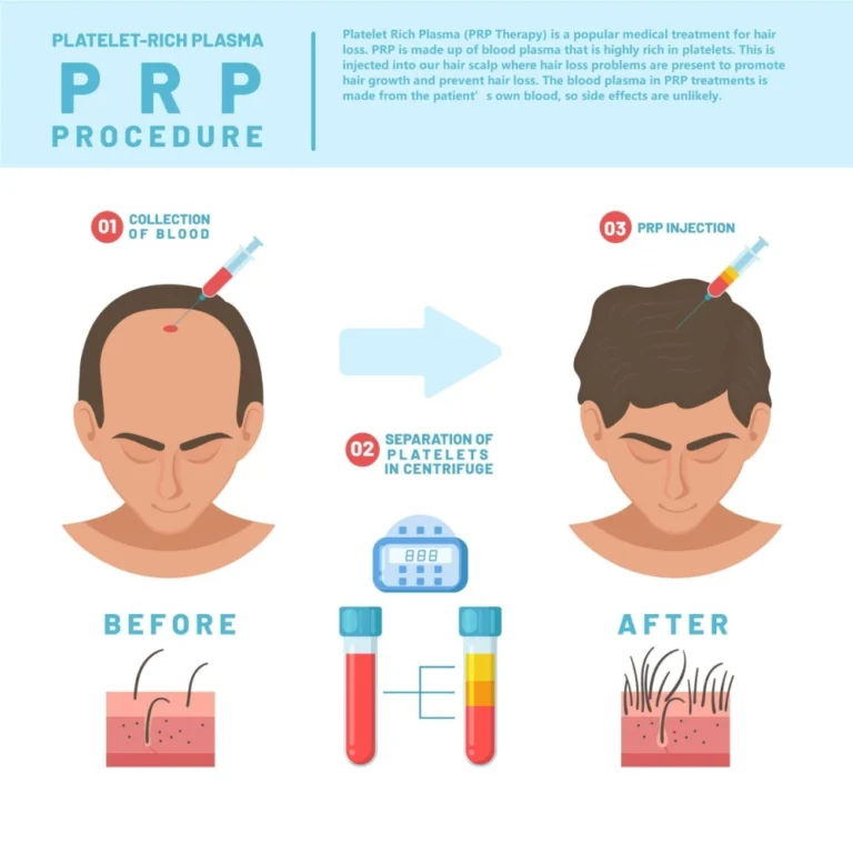 prp-hair-loss-treatment-malaysia-non-surgical