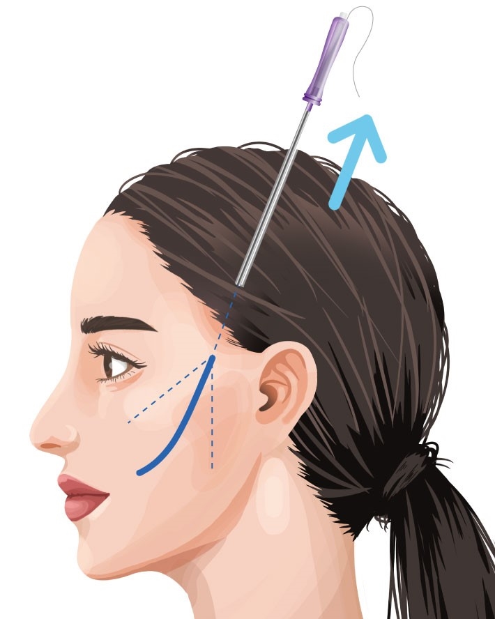 thread-lift-facelift-kl-malaysia