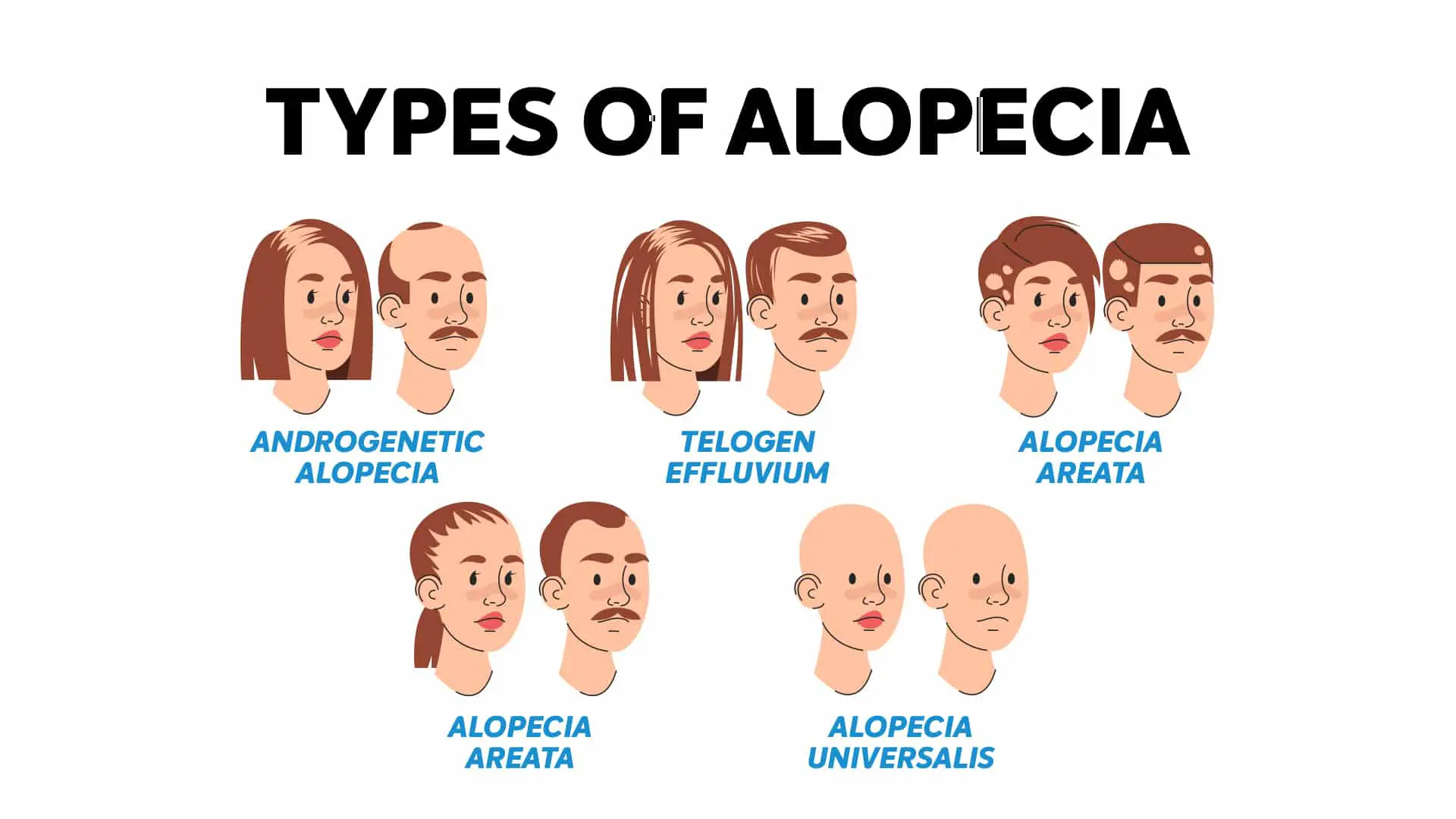hair-loss-types