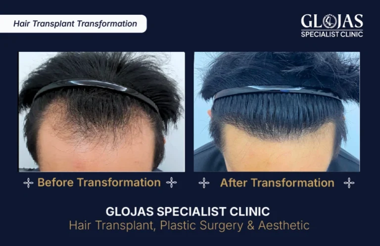hair-transplant-results-kuala-lumpur-malaysia