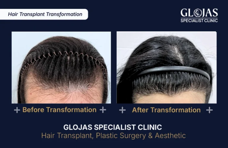 hair-transplant-results-kuala-lumpur-malaysia