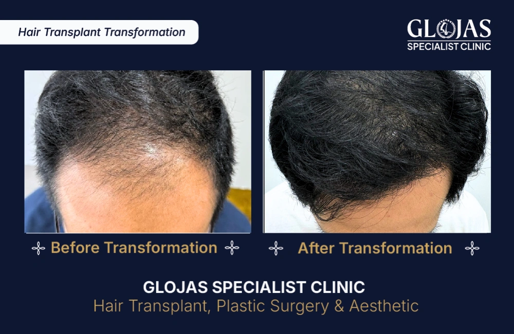 hair-transplant-results-kuala-lumpur-malaysia