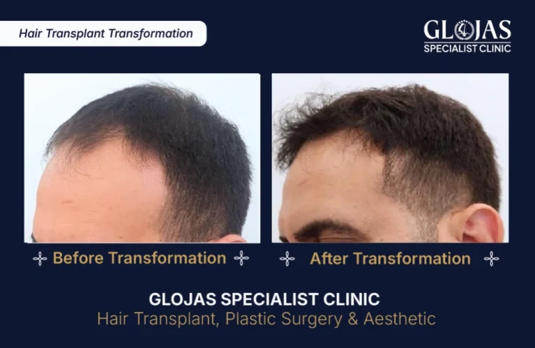 hair-transplant-results-kuala-lumpur-malaysia