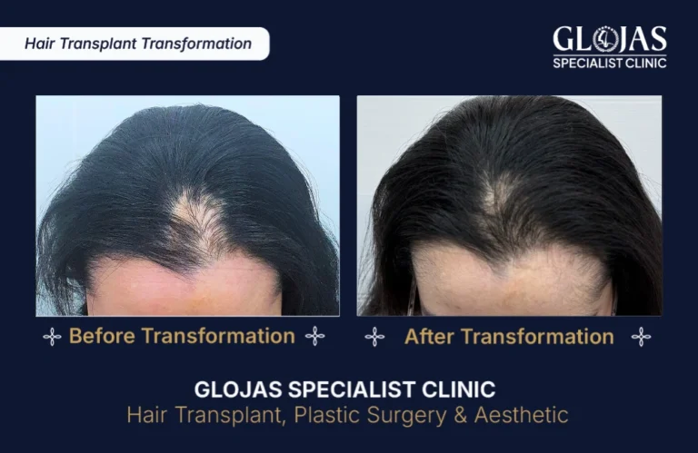 hair-transplant-results-kuala-lumpur-malaysia