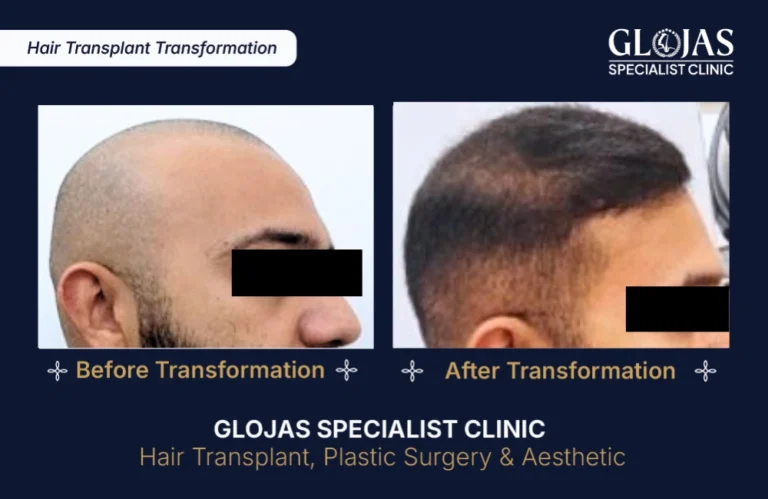hair-transplant-results-kuala-lumpur-malaysia