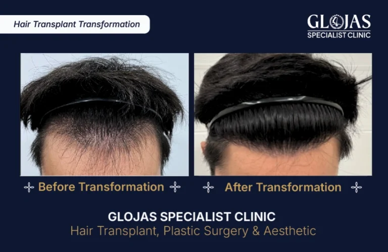 hair-transplant-results-kuala-lumpur-malaysia