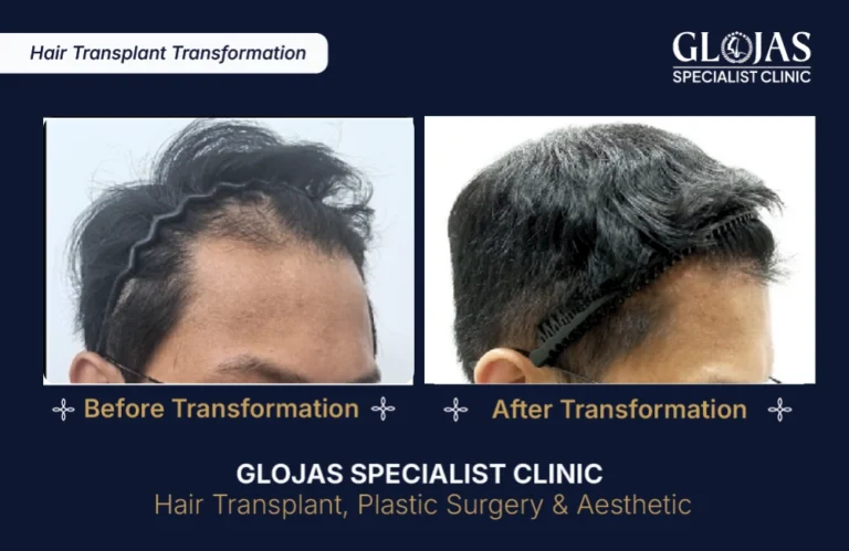 hair-transplant-results-kuala-lumpur-malaysia