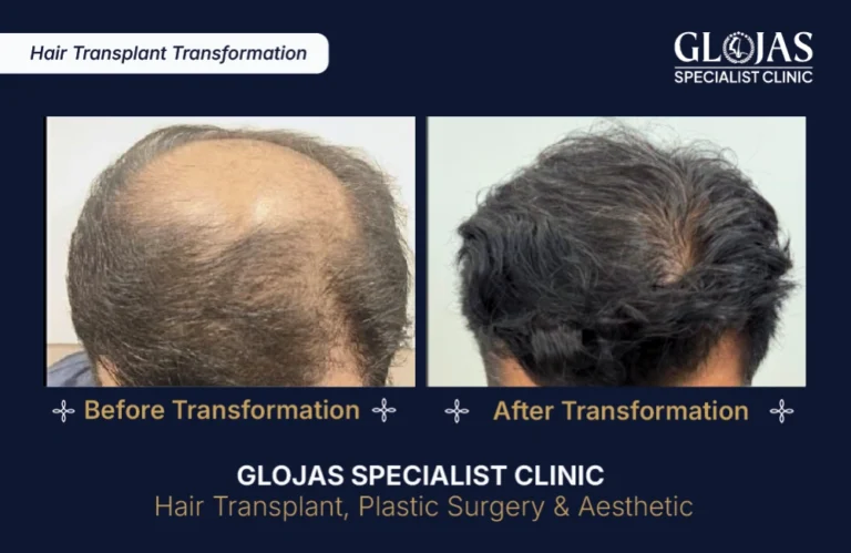 hair-transplant-results-kuala-lumpur-malaysia