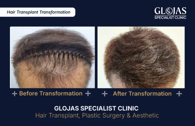 hair-transplant-results-kuala-lumpur-malaysia
