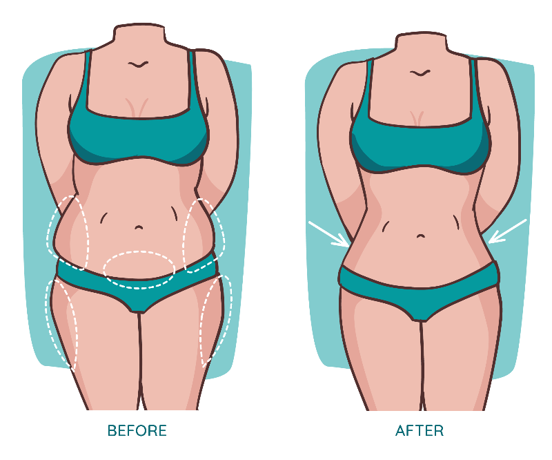 liposuction-body-contouring-malaysia-kl