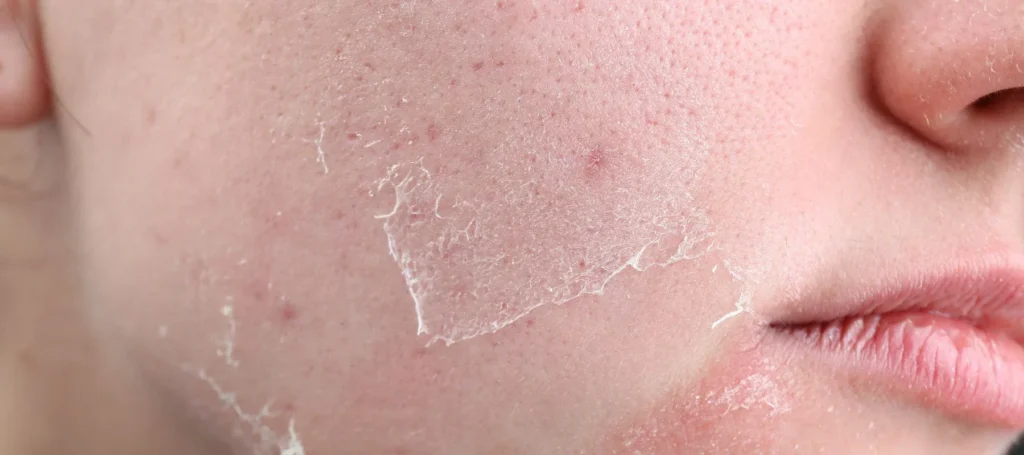 dead-skin-skin-dead-removal-how-to-remove-malaysia