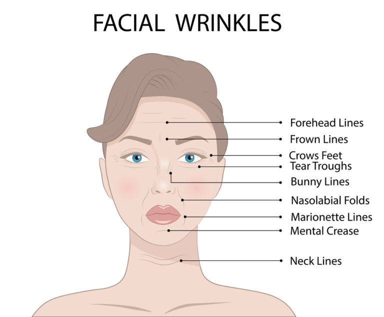 botox-areas