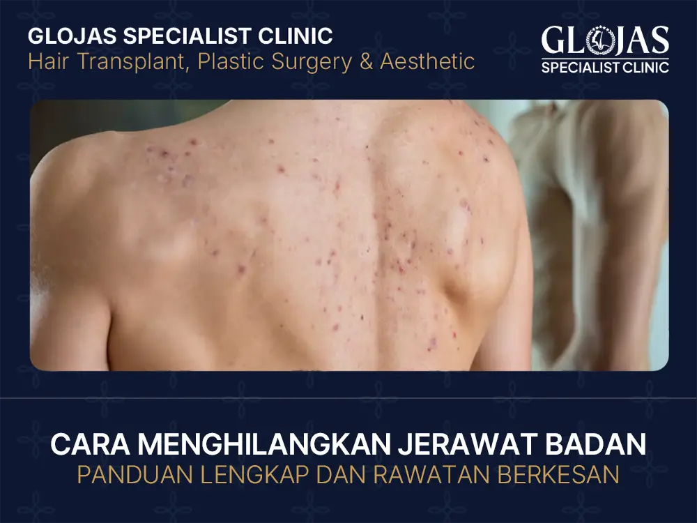 Punca & Cara Hilangkan Jerawat Badan Dengan Rawatan Berkesan