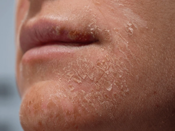 dead-skin-skin-dead-removal-how-to-remove-malaysia