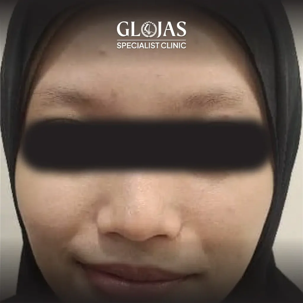 eyebrow transplant landing pageArtboard 1