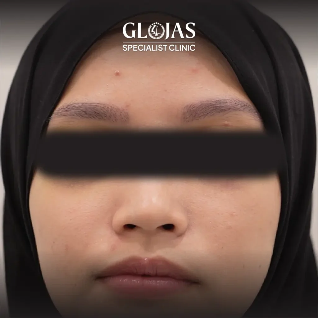 eyebrow transplant landing pageArtboard 2