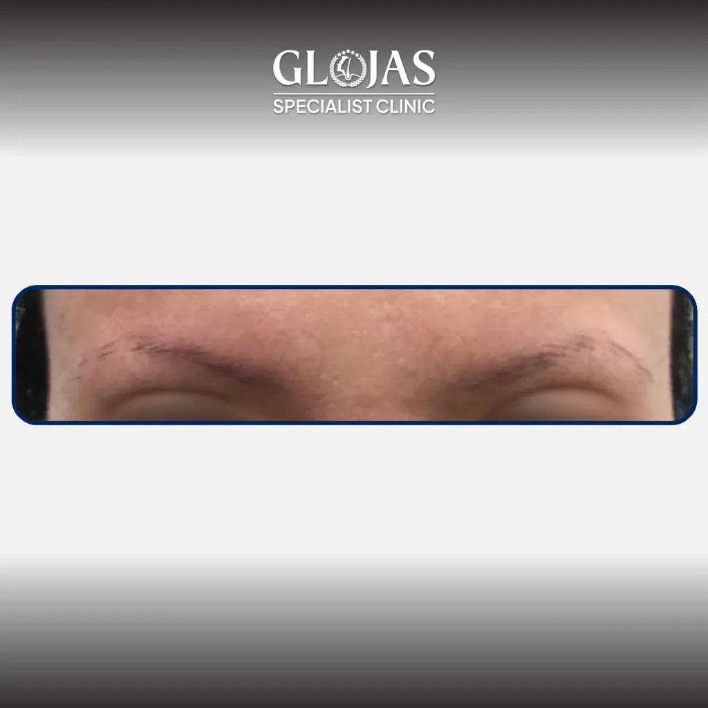 eyebrow transplant landing pageArtboard 5