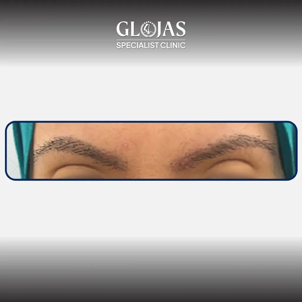 eyebrow transplant landing pageArtboard 6