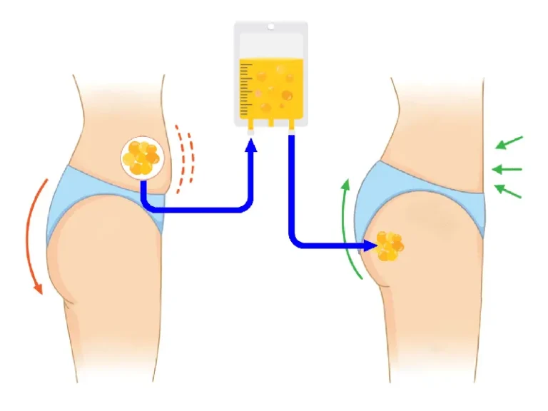 cara-besarkan-punggung-fat-transfer-malaysia